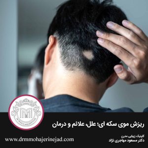 ریزش موی سکه ای؛ علل، علائم و درمان