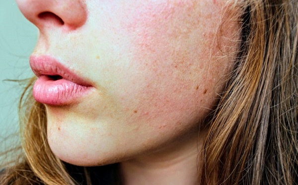 برخی از بیماری های پوستی ممکن است با تغییر فصل تشدید شوند.